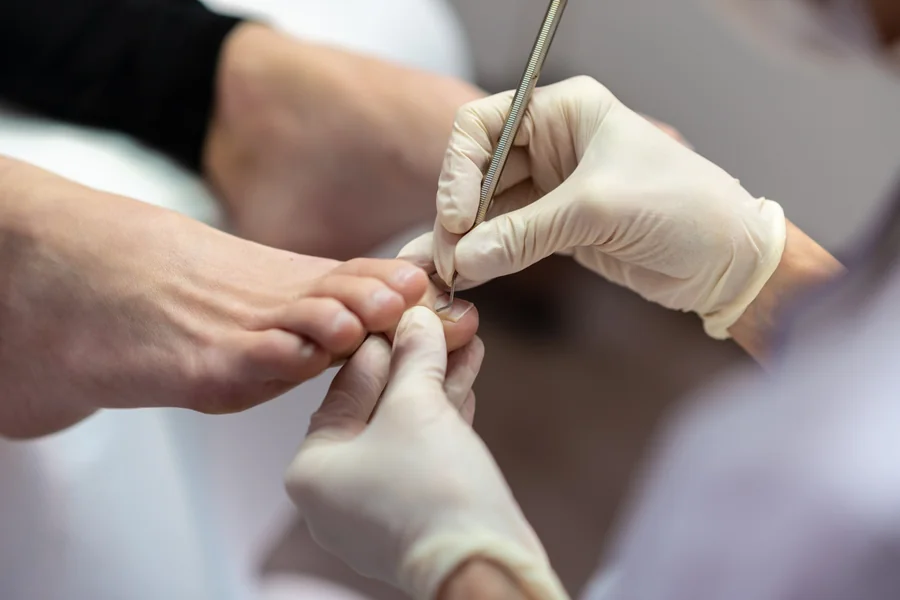Understanding Paronychia That Annoying Nail Infection